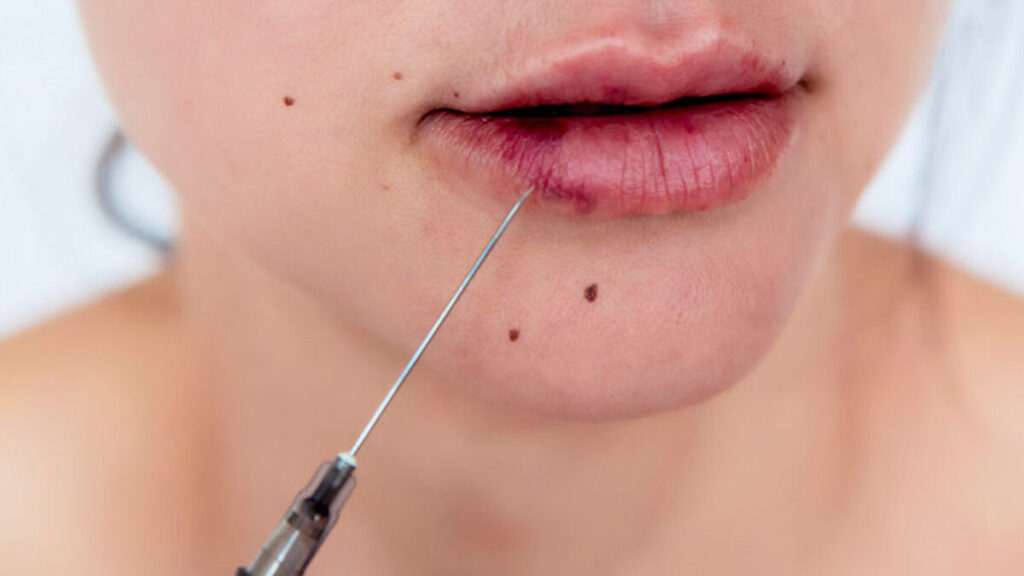 Role of HBOT in Managing Vascular Occlusion Caused Due to Fillers